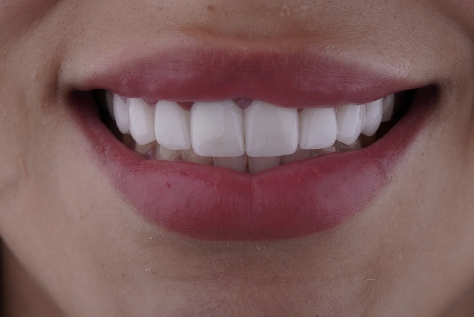 Smile Result Case 4