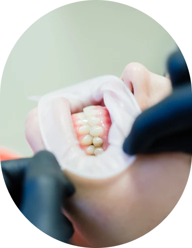 Gum Trimming Treatment - Dr. Sonia Herrera